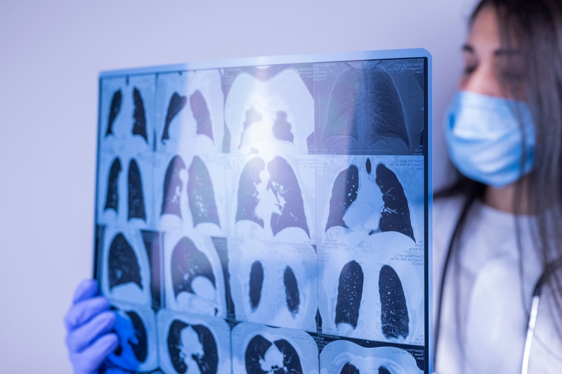 tratamento da pneumocistose