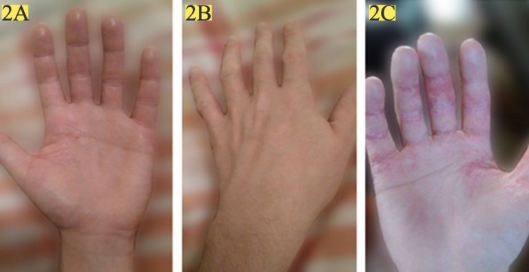 A foto 2C mostra a palma da mão do paciente antes do tratamento. As fotos 2A e 2B mostram a palma e as costas da mão após os três meses de aplicação da emulsão com óleo de semente de cânhamo