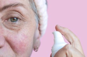 Rosácea e canabidiol: como CBD pode complementar o tratamento dermatológico