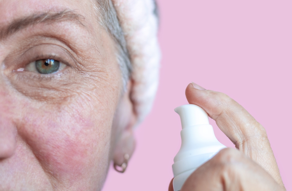 Rosácea e canabidiol: como CBD pode complementar o tratamento dermatológico