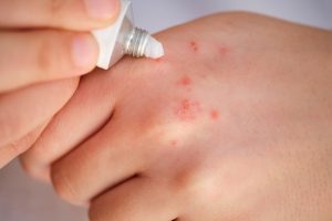 Dermatite atópica: como os canabinoides podem ajudar no tratamento dos sintomas