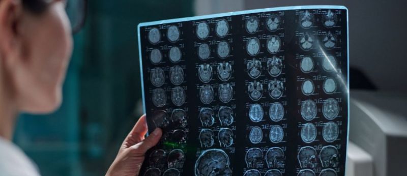 Cannabis pode melhorar sintomas urinários da esclerose múltipla diz estudo