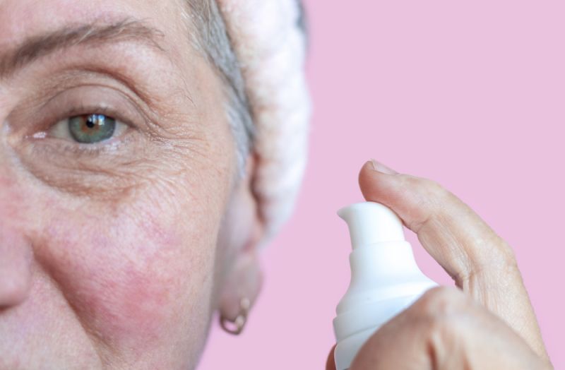 Rosácea e canabidiol: como CBD pode complementar o tratamento dermatológico